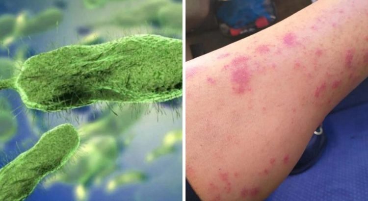 Continúan los casos de contagio con bacteria come carne en Texas